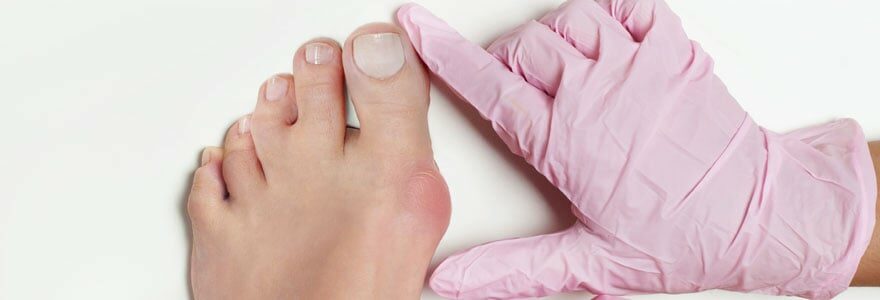 Hallux valgus